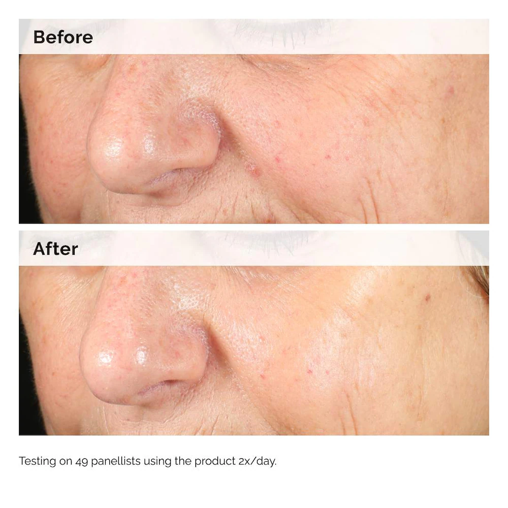 Hyaluronic Acid for Hyperpigmentation - Image 5
